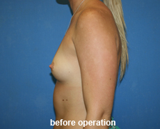 plastic-surgery-breast-augmentation